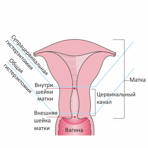 TCM 3000BL Морцеллятор NOUVAG AG